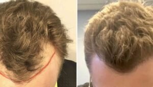 Hair Transplant Turkey