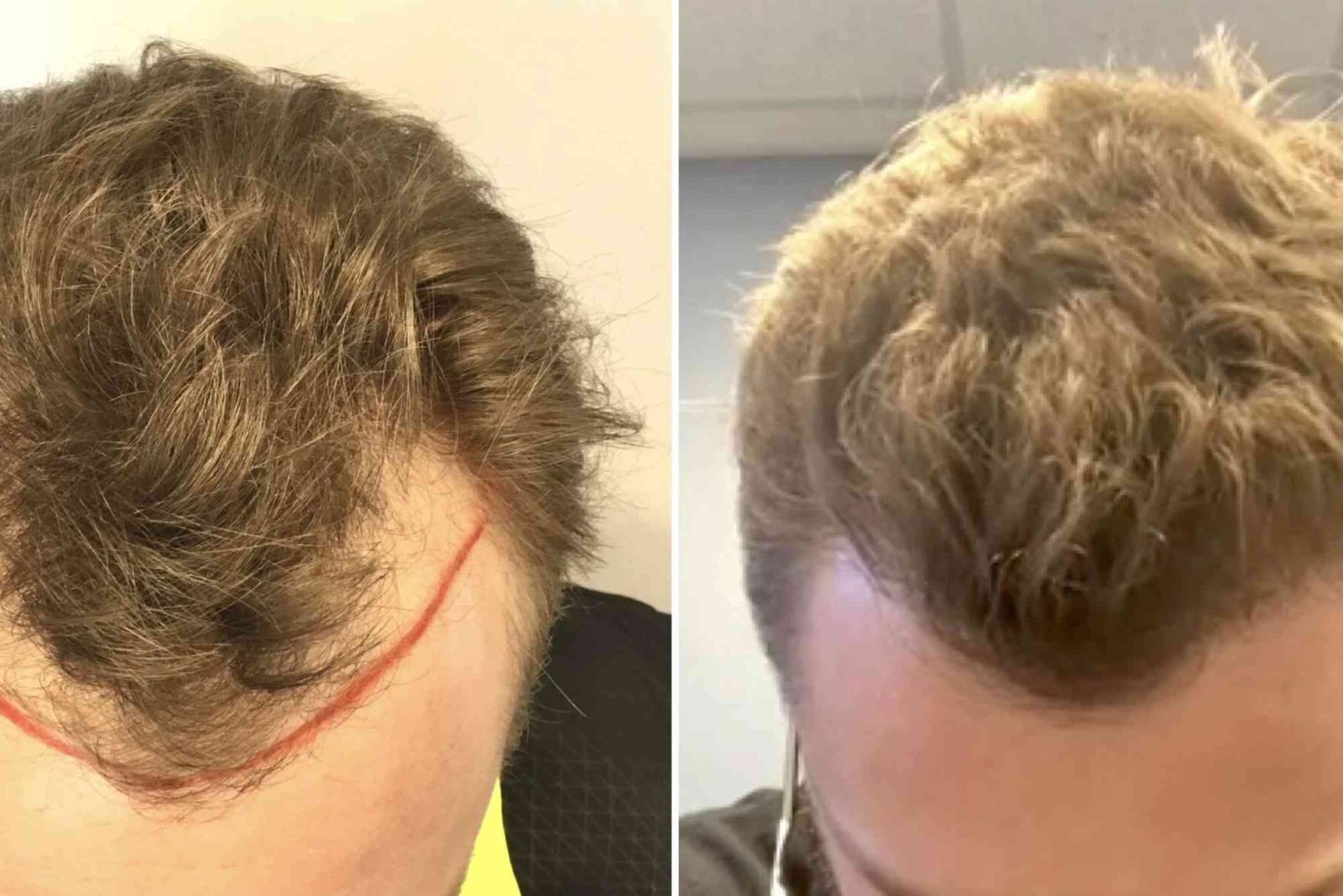 Hair Transplant Turkey